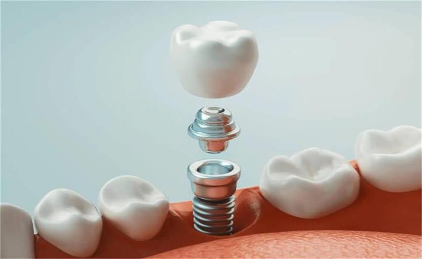 Key Manufacturing Technologies for Implantes Dentales: Metal Processing Technology and Surface Treatment Technology