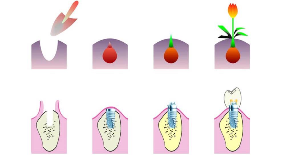 4 types of dental implants: types, material selection and processing methods explained
