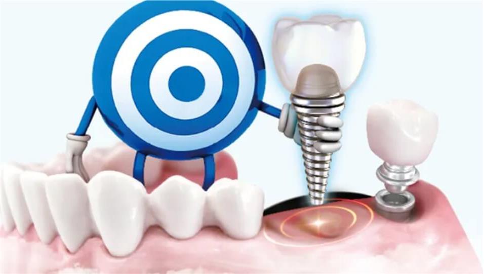 What are teeth implants made of? Material Secrets