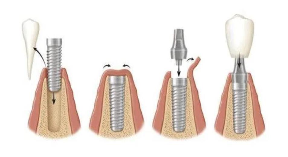 Titanium dental implants: an ideal solution for achieving stable bone integration