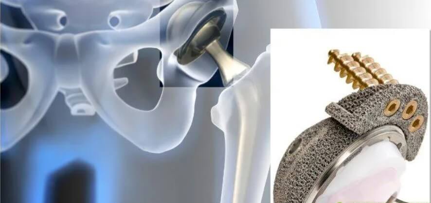 personalized hip implant